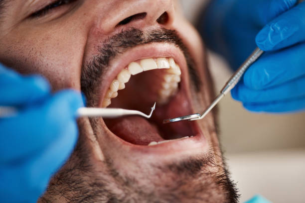 Best Emergency Root Canal Treatment in Myersville, MD